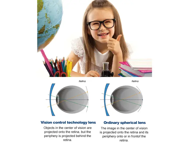 lentilles à défocalisation périphérique myovision-defocus-kids-myopia-control-single-vision-lens-1