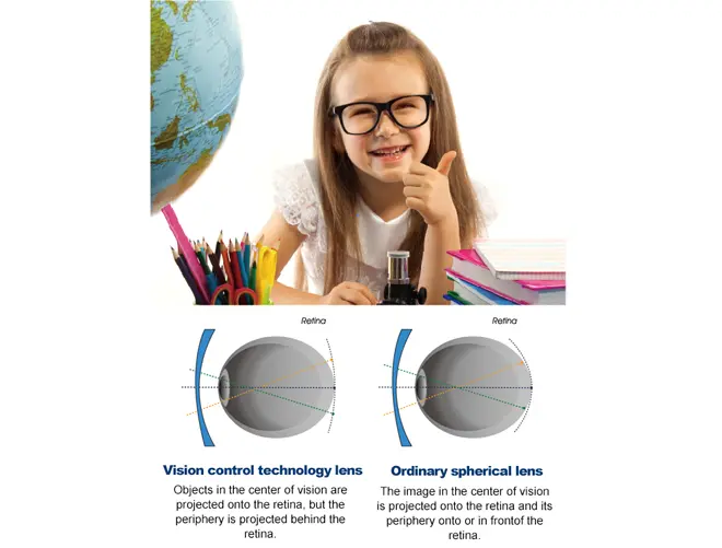 Spécification du verre unifocal de contrôle de la myopie à défocalisation périphérique pour enfants